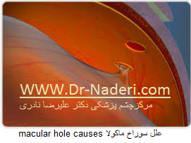 macular hole causes علل سوراخ ماکولا 